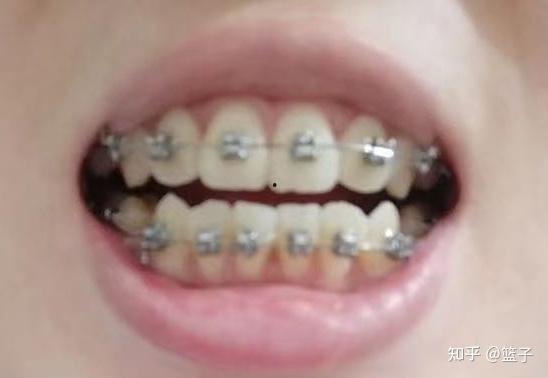 成人牙齿能做饰品吗视频,成人牙齿创意新用途探索-第1张图片-午夜成人福利影院 成人牙齿能做饰品吗视频,成人牙齿创意新用途探索-第1张图片-午夜成人福利影院