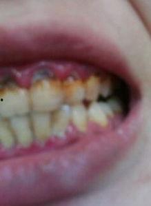 成人牙齿被腐蚀视频播放,视频揭示惊人真相-第1张图片-午夜成人福利影院