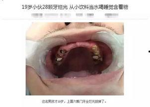 成人牙齿被腐蚀视频播放,视频揭示惊人真相-第3张图片-午夜成人福利影院